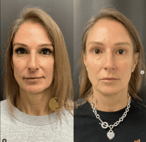 Is there anything better than this natural result that will just continue to improve with time?! Sculptra is a powerful product that contains Poly-L-Lactic Acid, which is a potent collagen stimulator that helps to restore fullness to the face and soften wrinkles and folds. This results in a more youthful, balanced and softer appearance. The best part is that these results gradually occur and continue to improve over the course of 12 months. This patient was treated with 2 vials and it is clear she has significant improvement in her overall facial volume and fat pads which has resulted in such a beautiful youthful appearance. Book today to see if you are a good candidate for this treatment!
